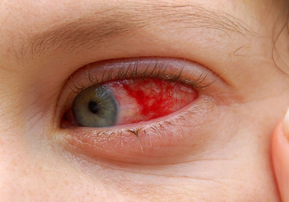 A hanseníase pode afetar os olhos: saiba como evitar a cegueira